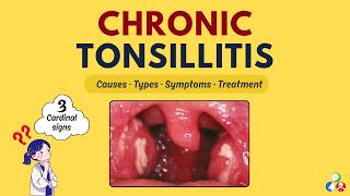 Chronic Tonsillitis | Definition, Causes, Types, Symptoms, Treatment, Complications
