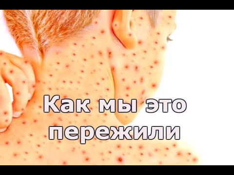 Ветрянка средней степени тяжести / Ветряная оспа у ребенка и подростка