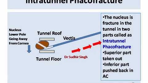 Intratunnel Phacofracture MSICS Basics : Animation and Video