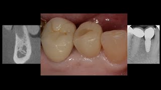 Lower right premolar replaced with a dental Implant by Dr Kuljeet Singh Mehta-Periodontist 2,889 views 1 year ago 9 minutes, 2 seconds