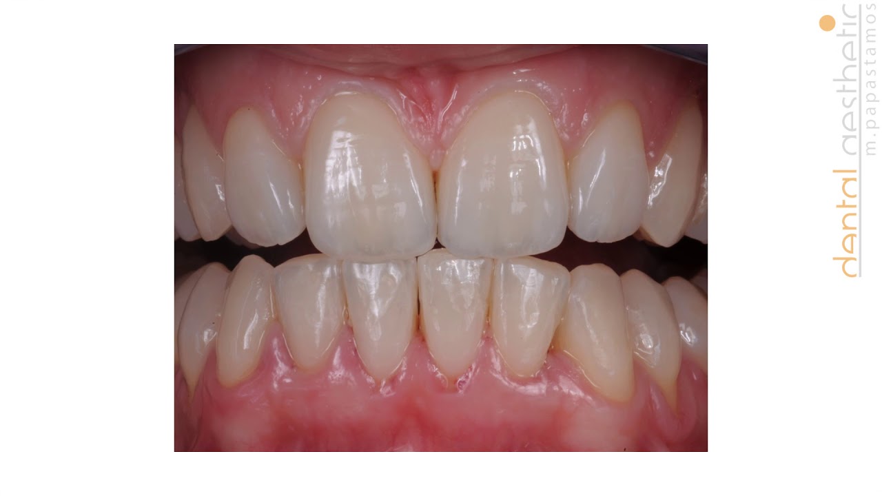 InLine 6 feldspathic veneers