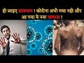 Monkey Pox के संक्रमण का कहर - कैसे बचेंगे? | Monkeypox Virus Explained?