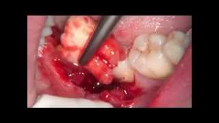 48 tooth extraction with microscop  (удаление зуба мудрости)(Удаление зуба мудрости с использованием дентального операционного микроскопа., 2014-05-12T16:26:18.000Z)