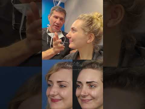 Video thumbnail: 8 Years Post Op Results! The Power Of Rhinoplasty
