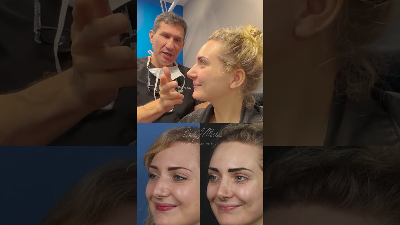 8 Years Post Op Results! The Power Of Rhinoplasty