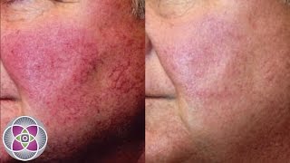 Removal Facial redness