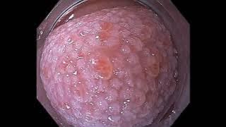 Gastroscope-assisted oral cavity and nasopharynx examination