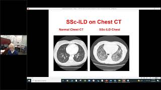 Scleroderma Clinical Treatment Trials- Are They Right For You? Maureen D. Mayes, MD, MPH