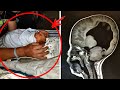 Ребенок родился "без мозга"... Спустя 3-года врач проводит обследование и обнаруживает это...