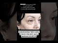 #eyelidsurgery #plasticsurgery #blepharoplasty