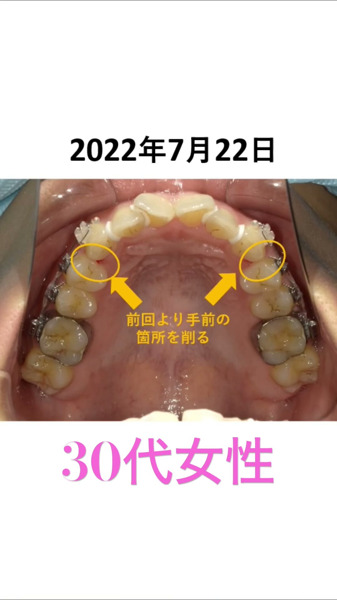 30代の非抜歯矯正治療 #矯正歯科 #歯医者 #braces - YouTube