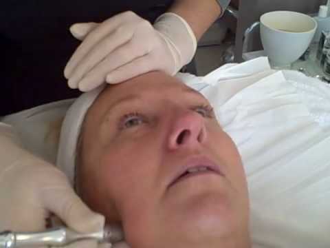 Microdermabrasio...  facial At Tracey Bell