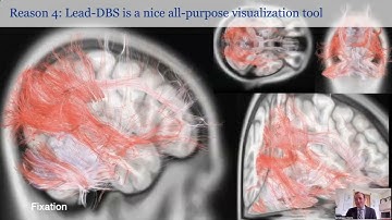 OHBM 2023 | Keynote | Andreas Horn | Connectomic Deep Brain Stimulation