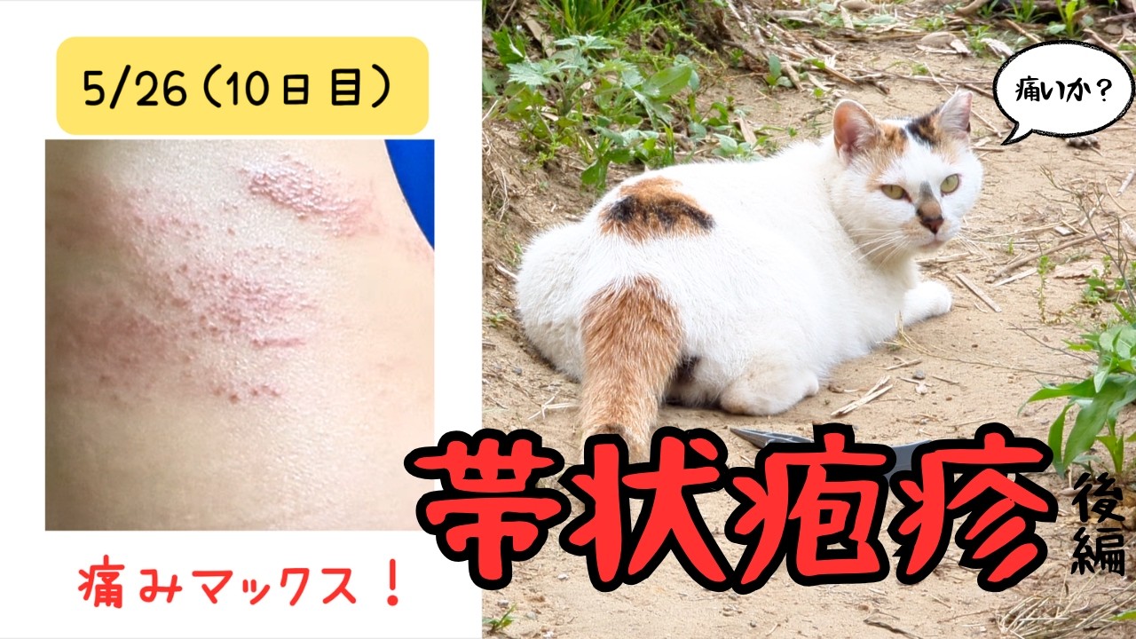 【廃墟の隣に棲む女】 ~帯状疱疹闘病記≪発疹から2週~3週目≫ 痛みと痒みとヒリヒリ感…まだ終わらない魔の手~#39