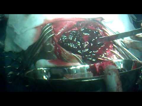 Brain Surgery by Dr Tushar Arora for removal of a big Blood clot at Apollo Ludhiana on 6th May 2011