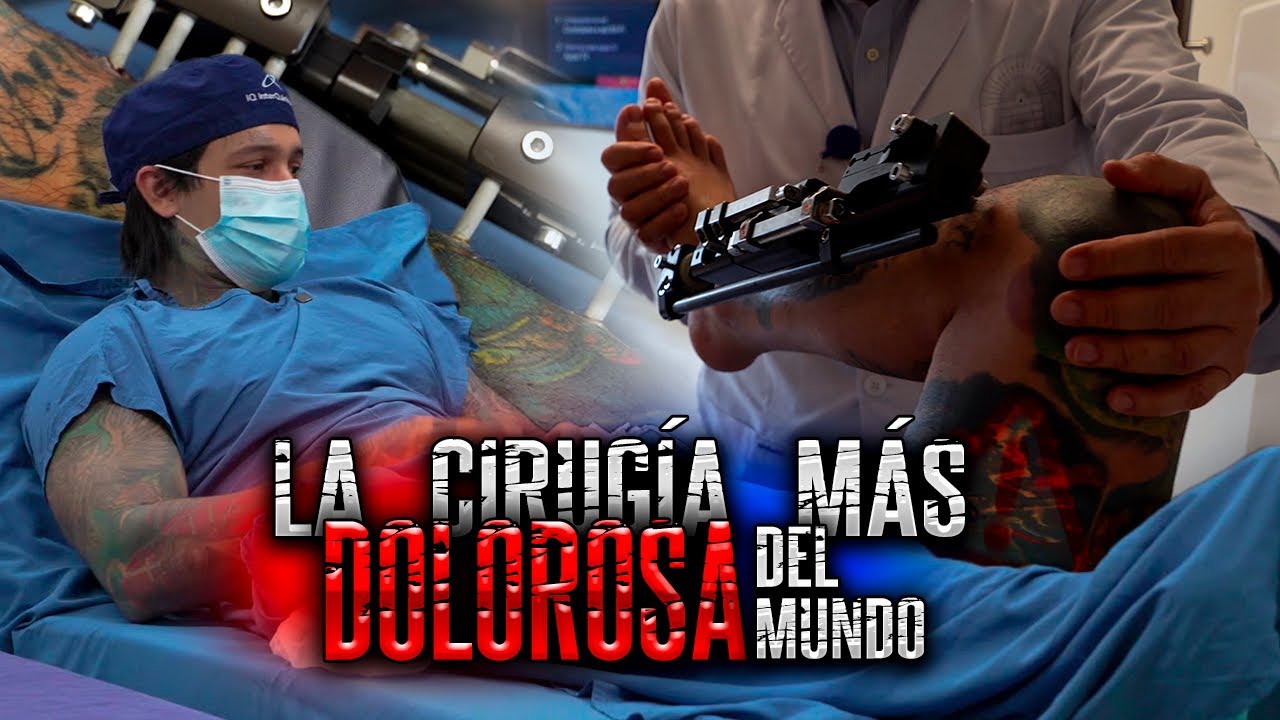 Mi alargamiento de piernas | Yeferson Cossio