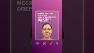 Ирина. Верхняя и нижняя блефаропластика. Месяц после операции