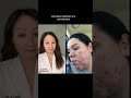 Doctor Reacts to Acne Transformation on Accutane #SHORTS