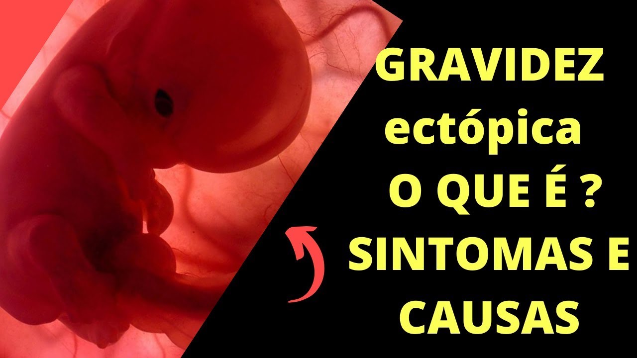 GRAVIDEZ ectópica (nas trompas) o que é sintomas e causas - YouTube