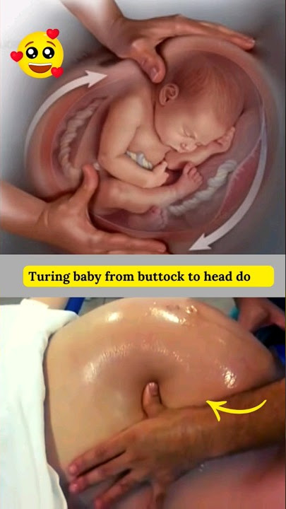 Membalikkan Bayi ke Posisi Kepala di Bawah 🥰 #shortvideo #ecv