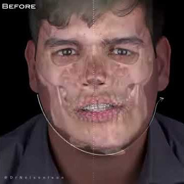 Orthognathic surgery results for asymmetric face