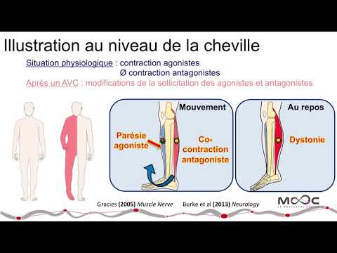 Vidéo: Comment la physiothérapie traite-t-elle la spasticité?