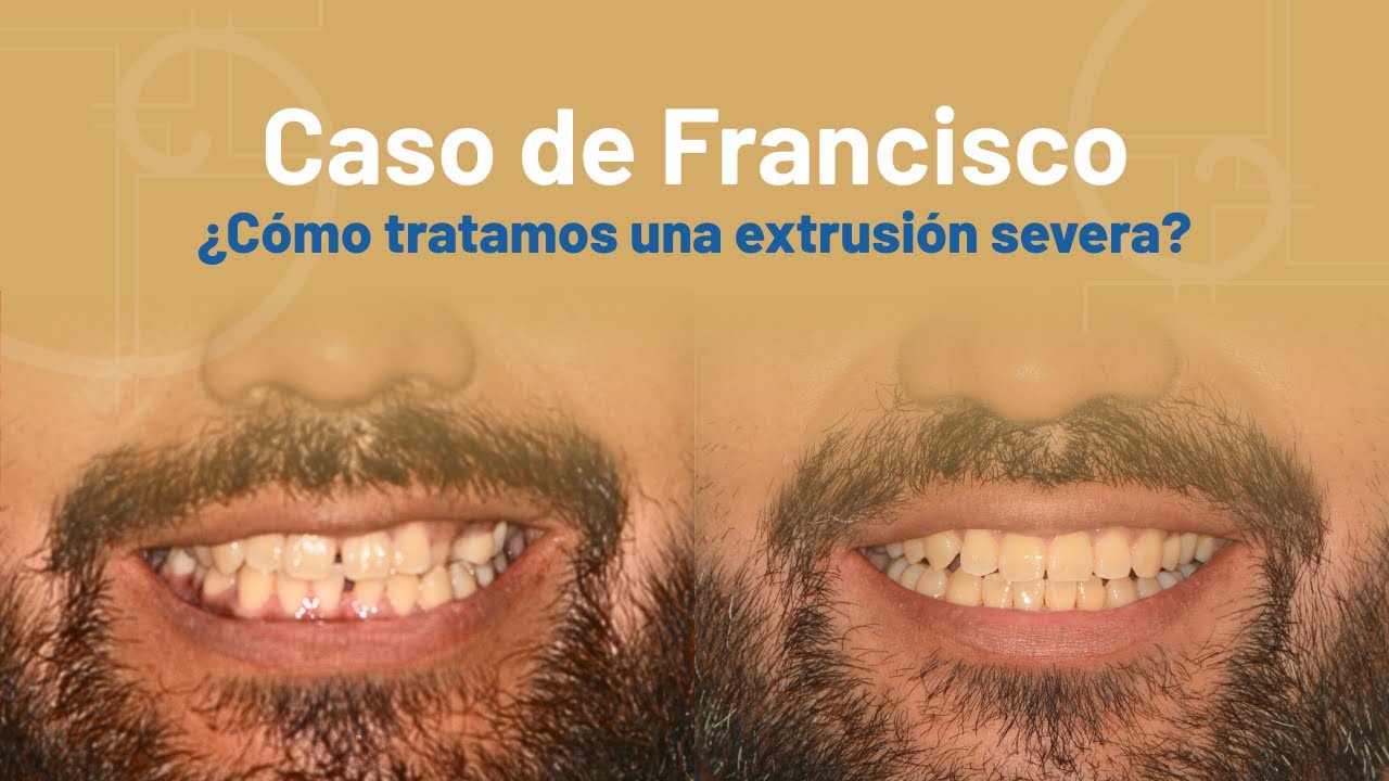 Extrusión molar y maloclusión Clase I: caso clínico real | Dental Phi