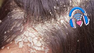 Relaxing Scalp Scratching | Thick Dandruff Gone D00376