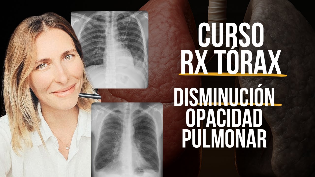 ¿No sabés leer una RX de tórax? Sigamos! ✅