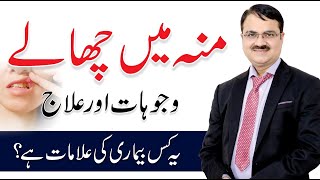 Moun Ke Chalon Ka Ilaj  Mouth Ulcer Causes & Treatment In Urdu/Hindi | Dr. Tariq Ali Sheikh