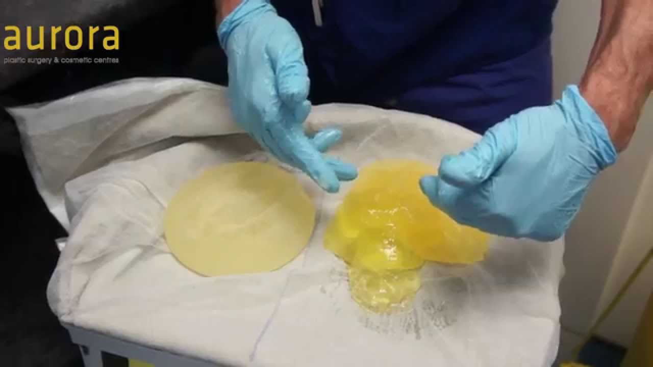 Silicone Breast Implants Leaking 65