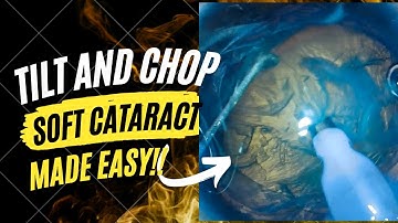 Case series 18. Soft cataract made easy!! Tilt and tumble, hydroprolapse, supracapsular phaco chop!!