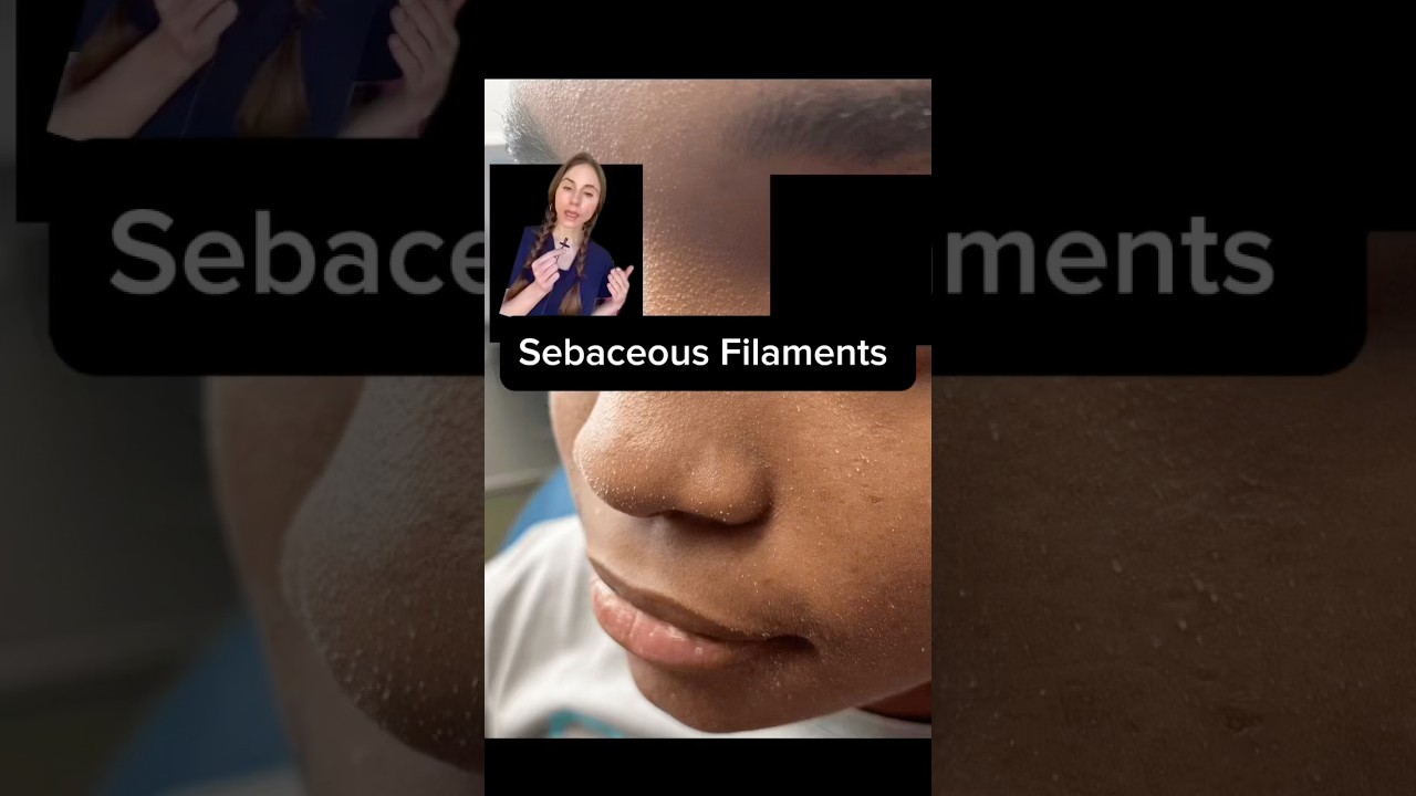 Skincare For Sebaceous Filaments & Face Mites 