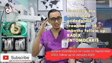 SINGLE VISIT ROOT CANAL TREATMENT IN MOLAR WITH RADIX ENTOMOLARIS, 16 MONTHS CONTROL, DIODE LASER 🦷