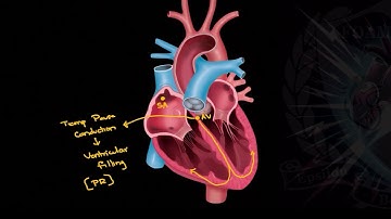 Should we use Adenosine in WPW with AFib? | Critical ECGs | Good Reads - 4-2024