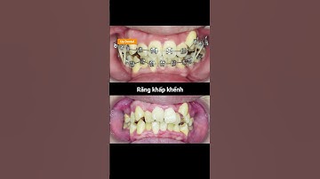 Cận cảnh quá trình niềng răng lệch lạc mức độ 2 tại Up Dental