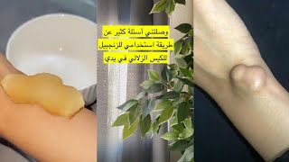 تجربتي الشخصية لعلاج الكيس الزلالي في مفصل اليد ~ Ganglion Cyst✨ حنان كعدور