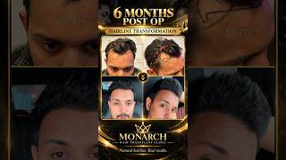 He Got His Hairline Back in 6 Months Only!