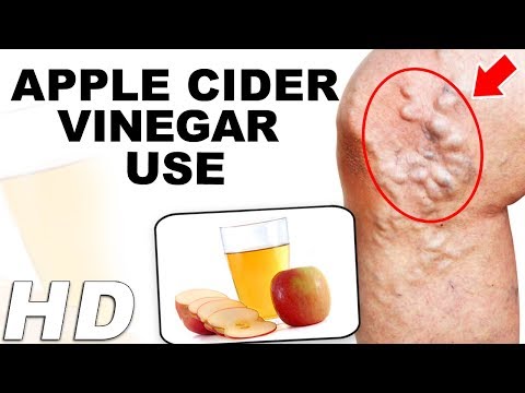 apple-cider-vinegar-use-for-varicose-veins-|-spider-veins-treatment