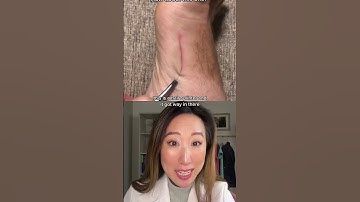 Thumbnail of Hair splinters are real things and can get infected #dermbypark #shorts #splinter
