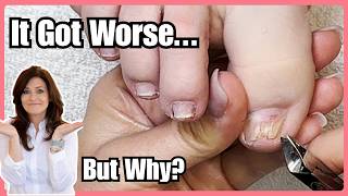 She Covered Her Damaged Big Toenails for a Wedding… Here’s What Happened