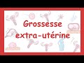 Grossesse extra-utérine -causes, symptômes, diagnostic, traitement