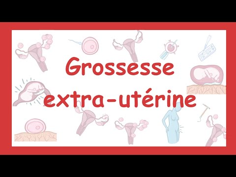 Vidéo: Grossesse extra-utérine