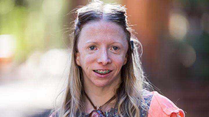 My Rare Facial Deformity Nearly Ruined My Life | B...