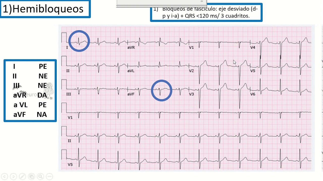 Hemibloqueos fasciculares y Bloqueos completos de rama (Datos-Tos