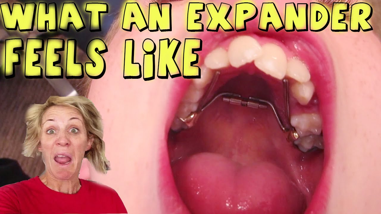 WHAT AN EXPANDER FEELS LIKE --THE JOURNEY WITH BRACES - YouTube