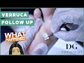 Verruca follow up (two appointments)