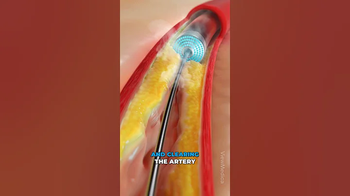 Vaporizing coronary blockages! (3D Animation)