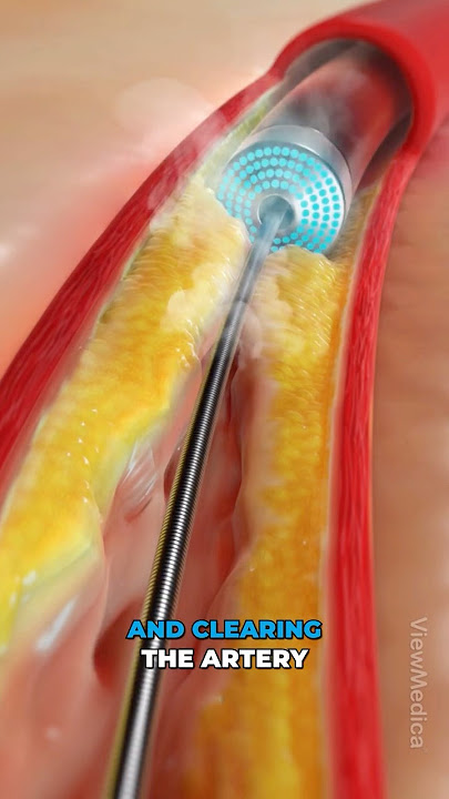 Vaporizing coronary blockages! (3D Animation)
