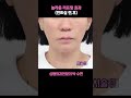 놀라운 리프팅 효과 (민트실 전, 후)!? #박수연원장#리프팅잘하는병원#민트실리프팅